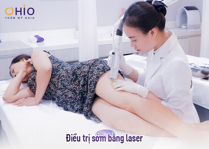 Trị giãn mao mạch chân bằng laser xung dài