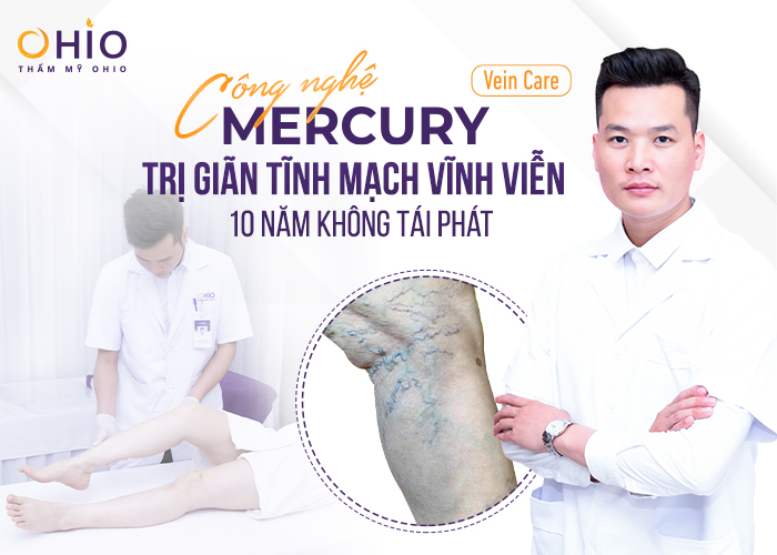 Trị giãn tĩnh mạch chân bằng công nghệ Mercury Vein Care