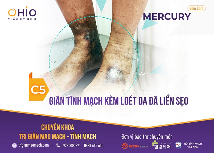 - Độ C5: Chân phù, sưng, nhức mỏi, biến đổi màu sắc da và vùng bị giãn tĩnh mạch trên chân sẽ viêm loét ở dạng thoái triển