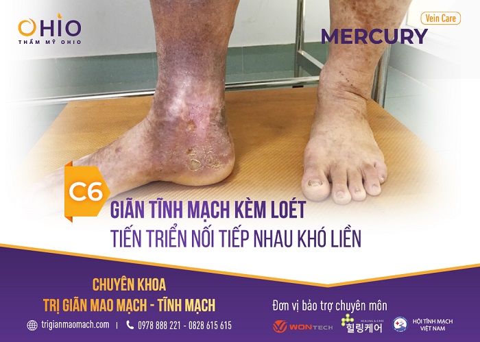 - Độ C6: Biến đổi màu sắc da chân vùng bị phù + viêm loét ở dạng tiến triển