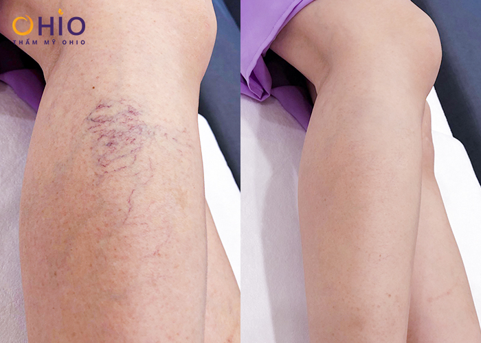 Trước và sau khi điều trị giãn tĩnh mạch chân mọi cấp độ bằng Mercury Vein Care 
