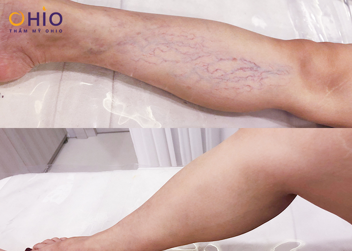 Trước và sau khi điều trị giãn tĩnh mạch chân mọi cấp độ bằng Mercury Vein Care 