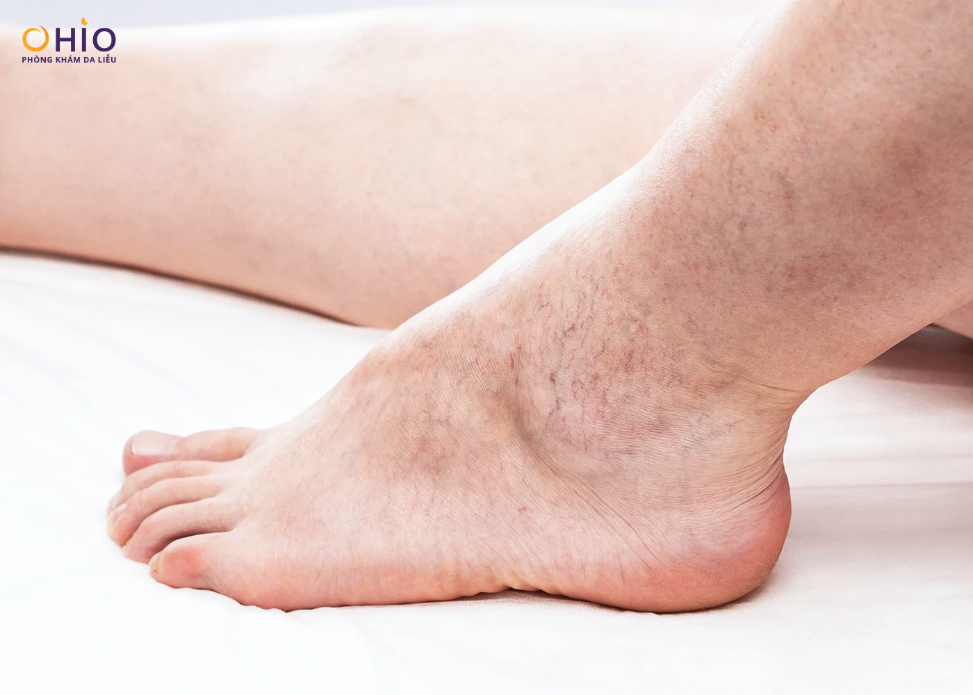 Tình trạng giãn mao mạch phổ biến