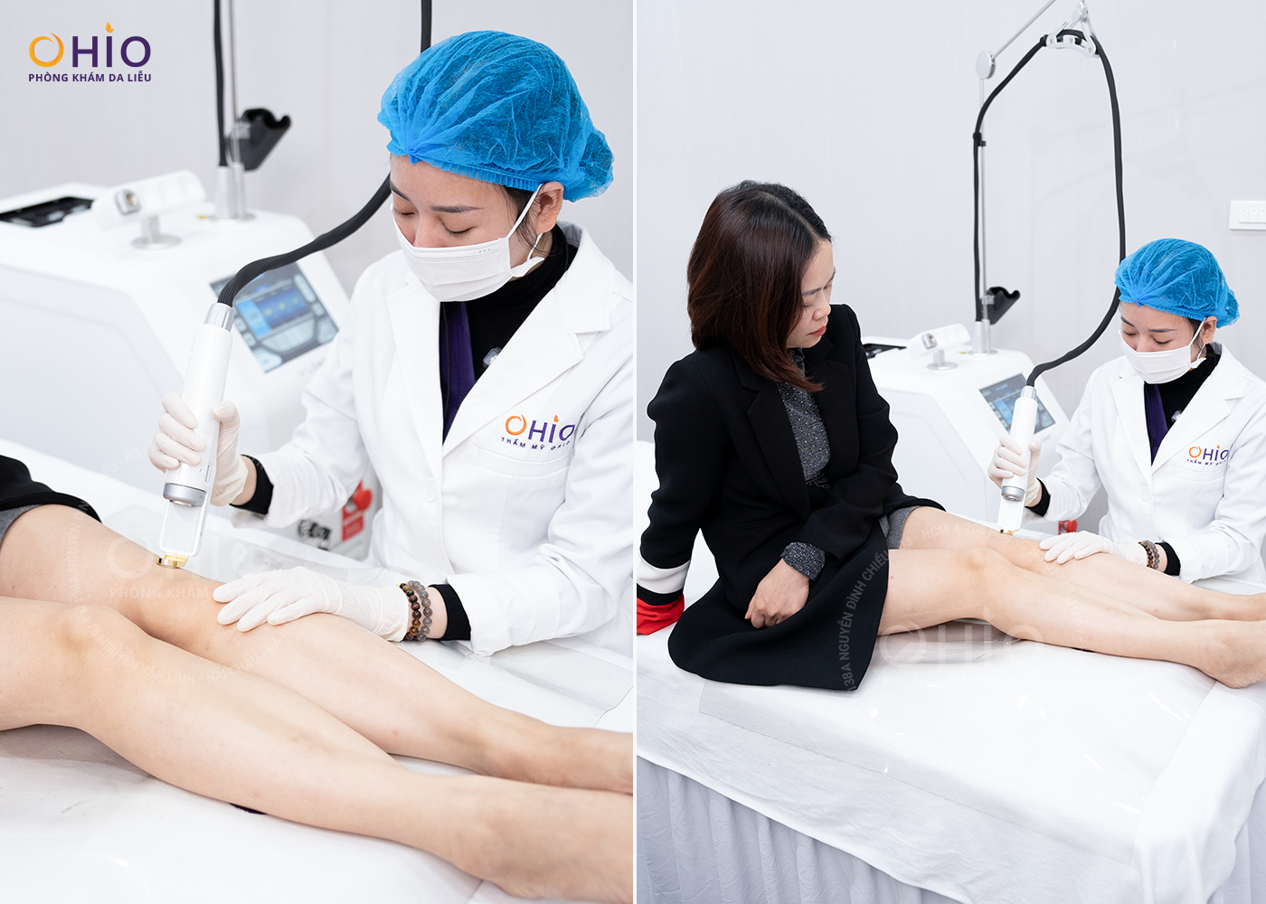 Điều trị giãn mao mạch bằng Tổ hợp Laser xung dài