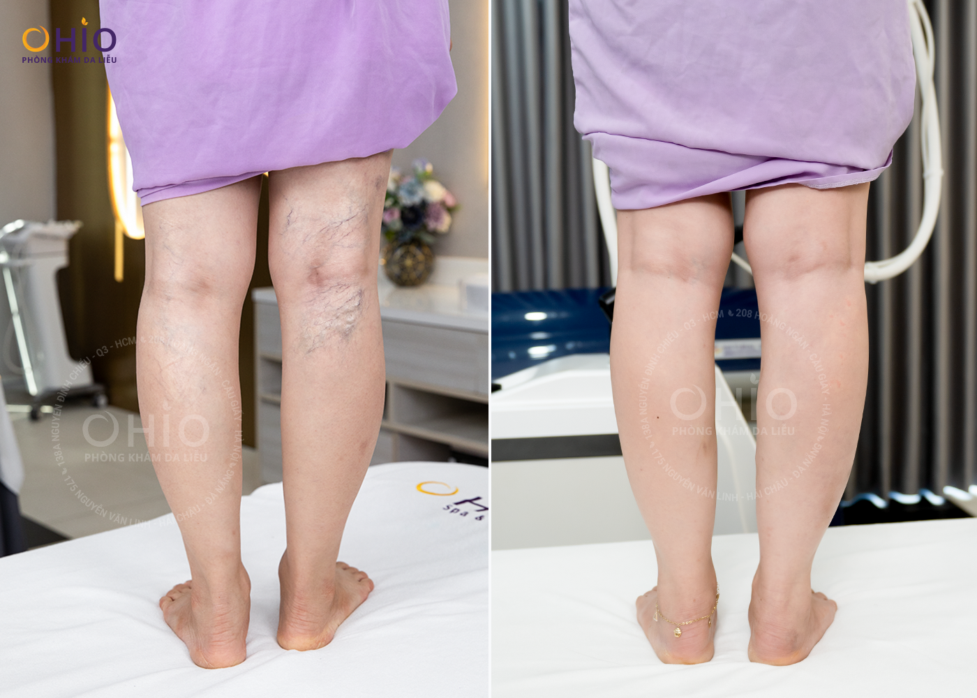 Tình trạng trước và sau của chị Ngọc Hồi