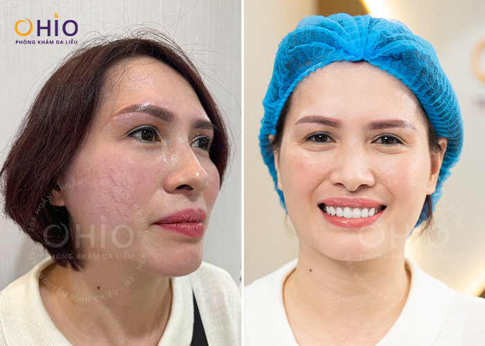 Chị Hương đã tự tin sạch giãn mao mạch