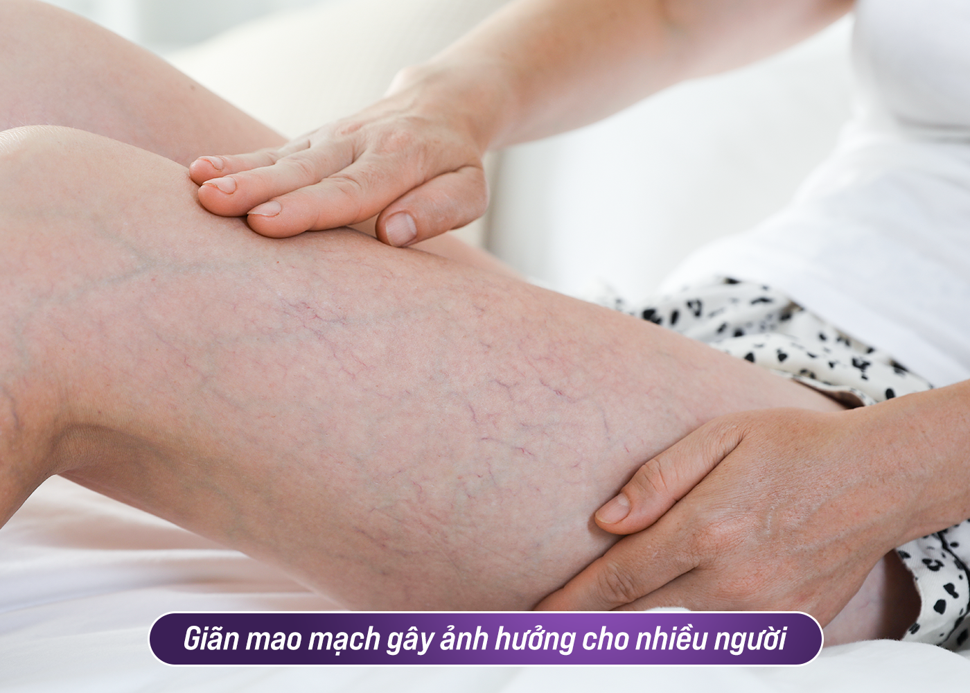 Tình trạng giãn mao mạch ảnh hưởng cuộc sống cá nhân