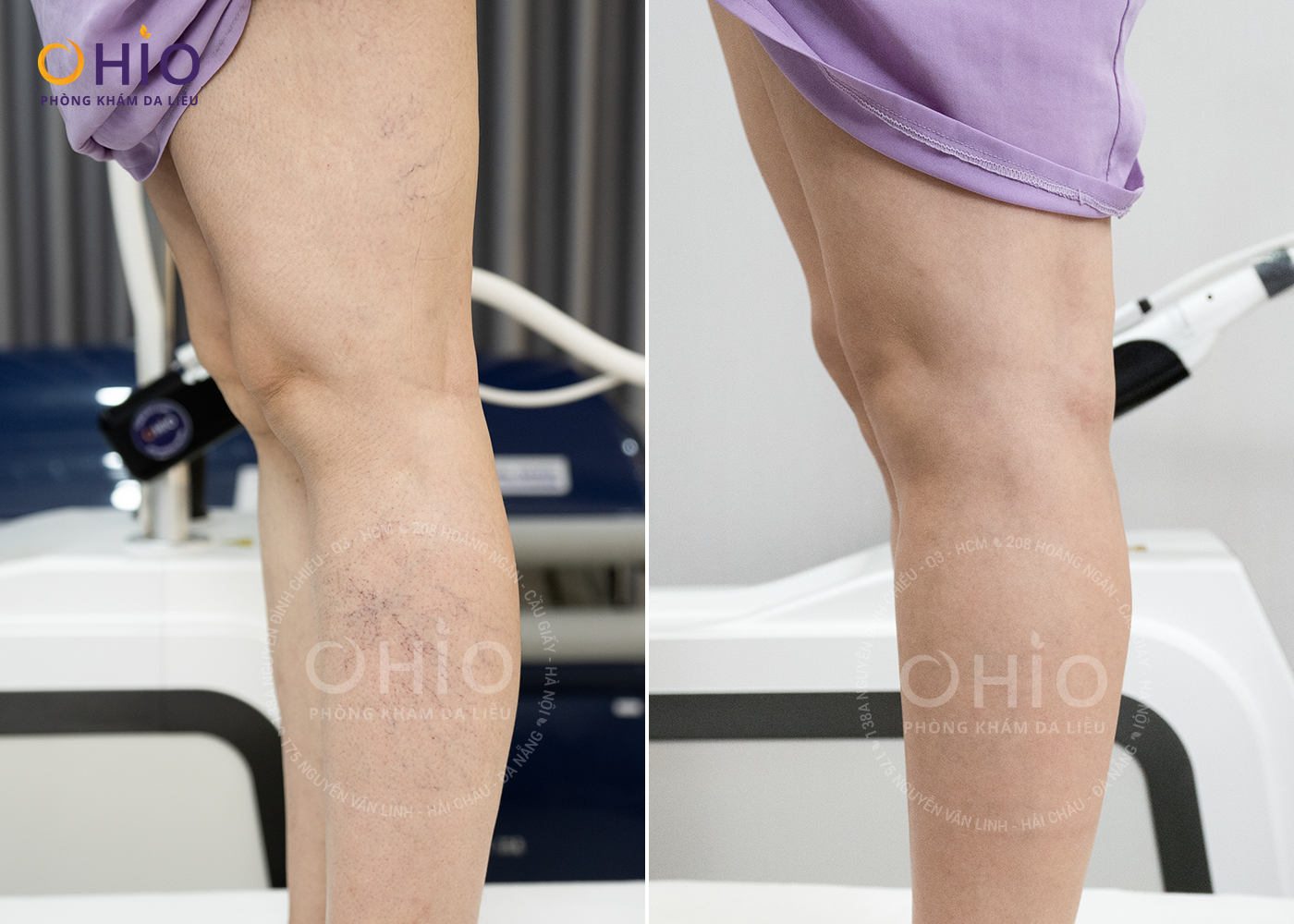 Kết quả điều trị giãn mao mạch của chị Hồng Ngọc