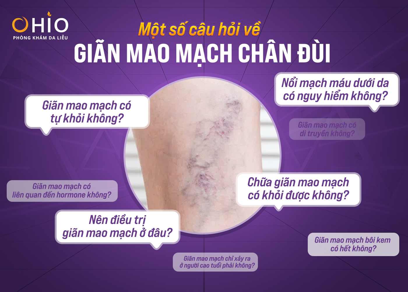 Một số câu hỏi về giãn mao mạch chân đùi